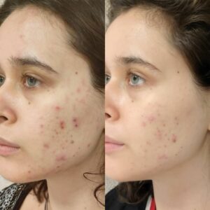 Cicatriz de acne