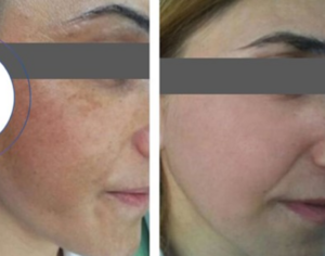 Melasma
